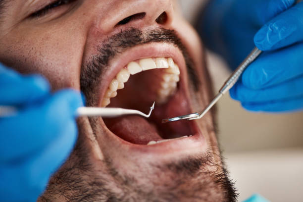 Best Emergency Tooth Extraction in Foresthill, CA